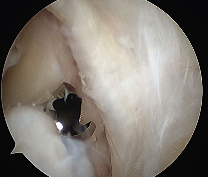 Mensical Root Repair Endobutton Drill